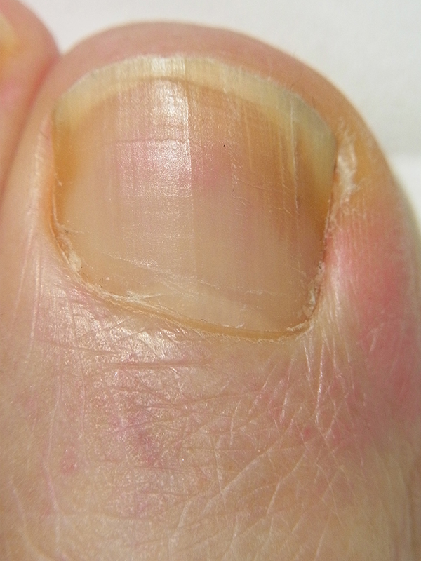 爪白癬治療後の親指の爪