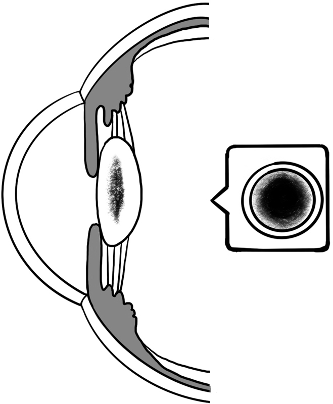 核白内障を発症した眼球のイラスト