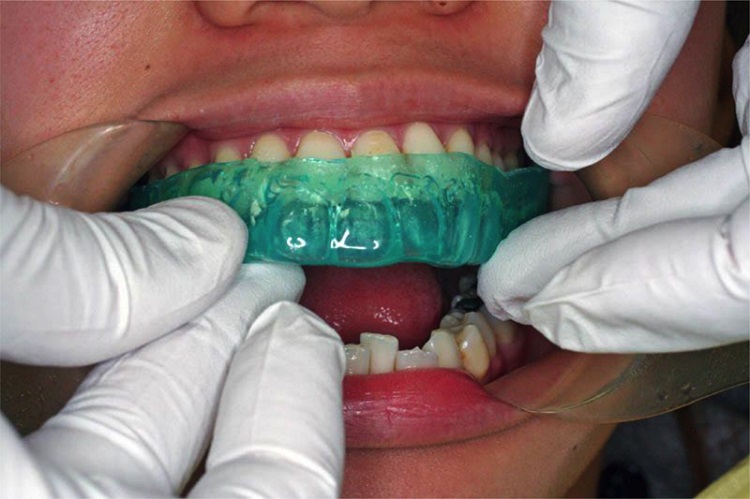 歯周病菌を一掃する最新口腔内除菌法「3DS」