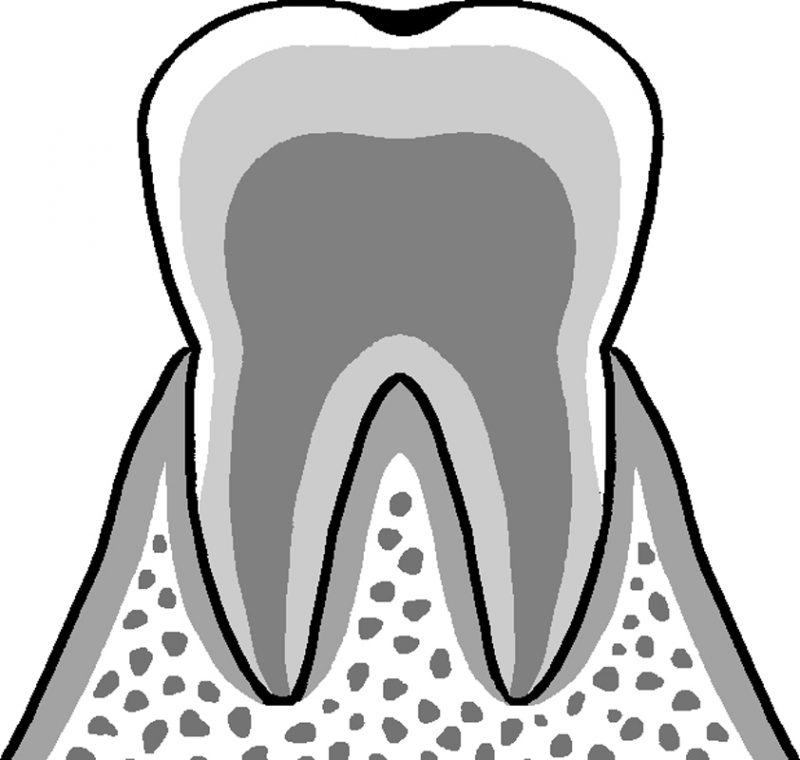 エナメル質と呼ばれる歯の表面部分が黒ずんでいたり、穴が空き始めている状態。