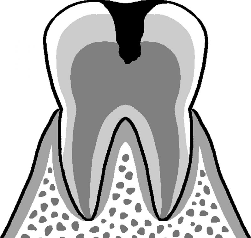 歯の奥の神経まで虫歯が進行。