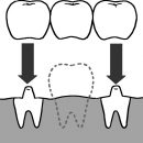 抜けた歯のスペースに、橋をかけるように両隣の歯を土台として、人工歯をかぶせる「ブリッジ」