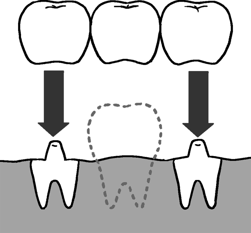抜けた歯のスペースに、橋をかけるように両隣の歯を土台として、人工歯をかぶせる「ブリッジ」