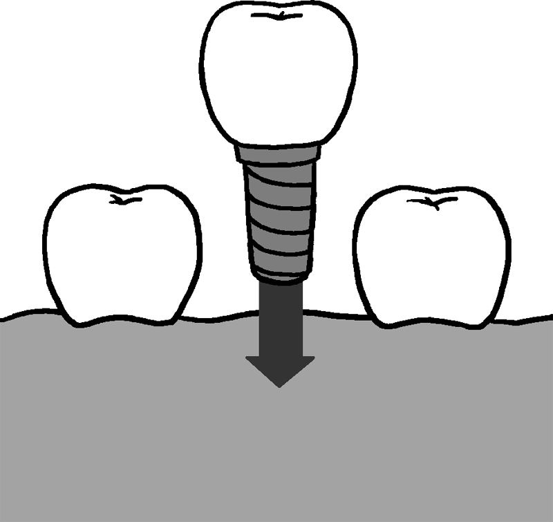 失った歯の根元にある顎の骨に、ネジのような器具を使って人工歯を埋め込む方法。「インプラント」
