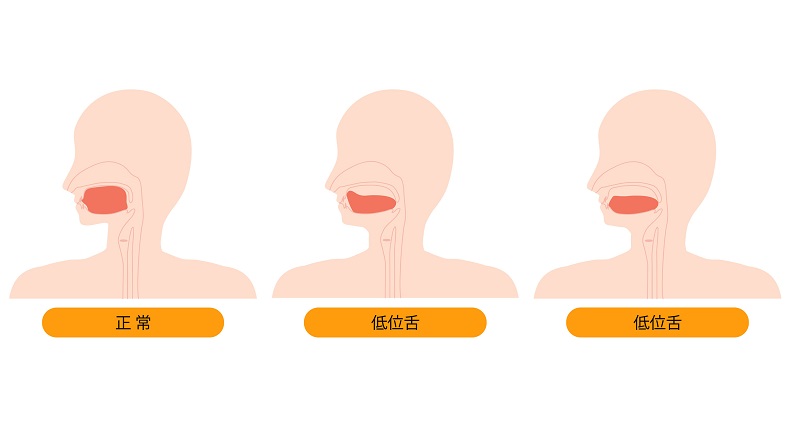 舌の位置、正常な位置と低位舌のイラスト