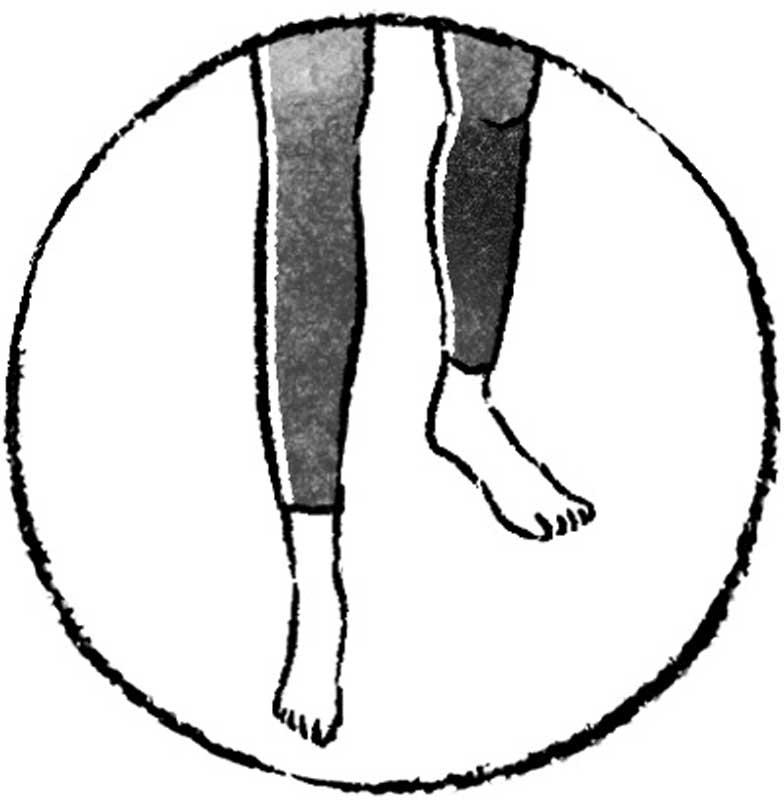 片足のひざと足先が斜め横に向いてしまっている足のイラスト