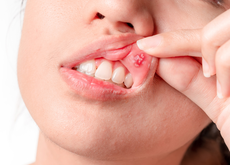 治し 口内炎 方 白い 白い口内炎、アフタ性口内炎の医学的特性と、効果的な治療方法
