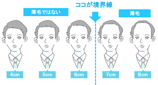 眉山からの距離6cmと7cmの間に、印象としての「薄毛の境界線」が