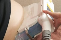 脂肪凍結ダイエット 脂肪細胞を冷却し死滅・体外排出させる