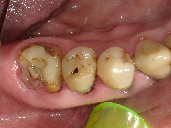 銀歯の下で虫歯が進行している