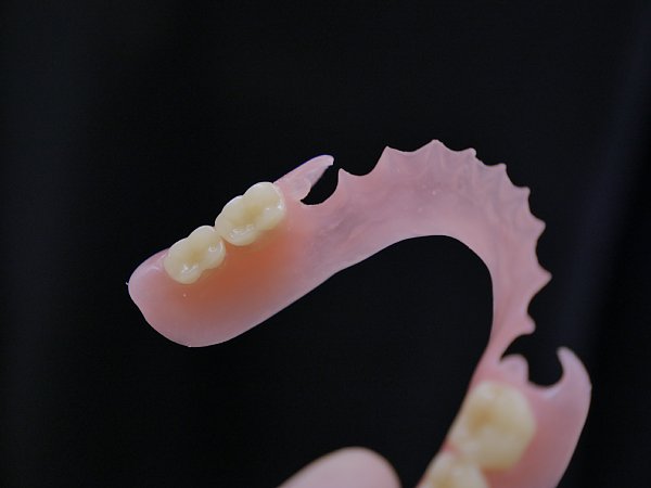 ノンクラスプ式の入れ歯