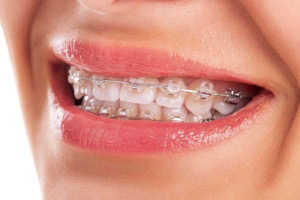 歯科矯正は不必要な早期治療も多い
