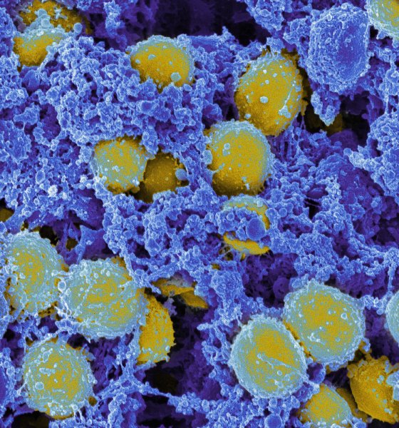 口内の黄色ブドウ球菌が肺炎の一因となる
