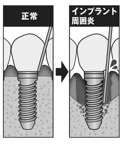 一生モノかと思いきや…