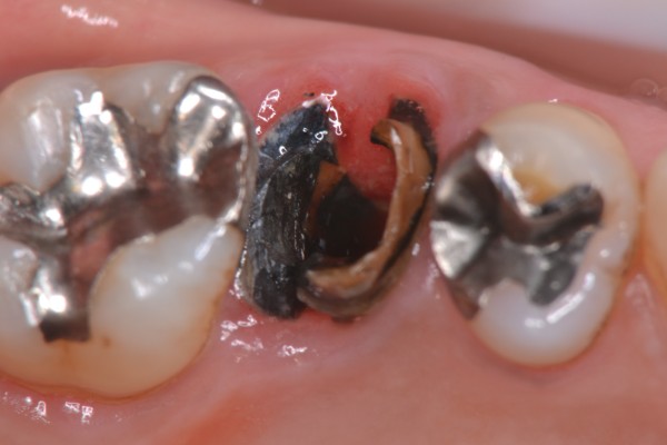 歯根が縦に割れても接着療法なら残すことが可能