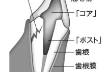 自覚症状がないまま歯を失わないための5つの対策
