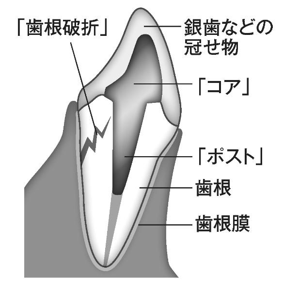 歯根破折の図解
