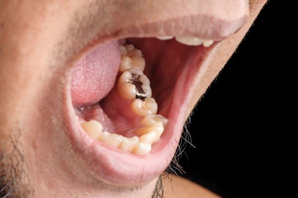 「銀歯」が歯を失う原因に！？（写真／アフロ）