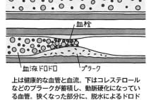 脳梗塞や心筋梗塞は夏にも発症、脱水症状が引き金になることも