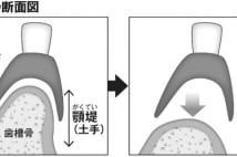 入れ歯で命失う人続出 餅を喉に詰まらせる窒息死の原因にも