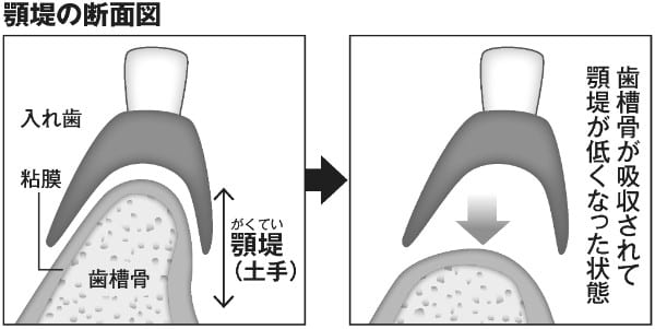 顎堤の断面図