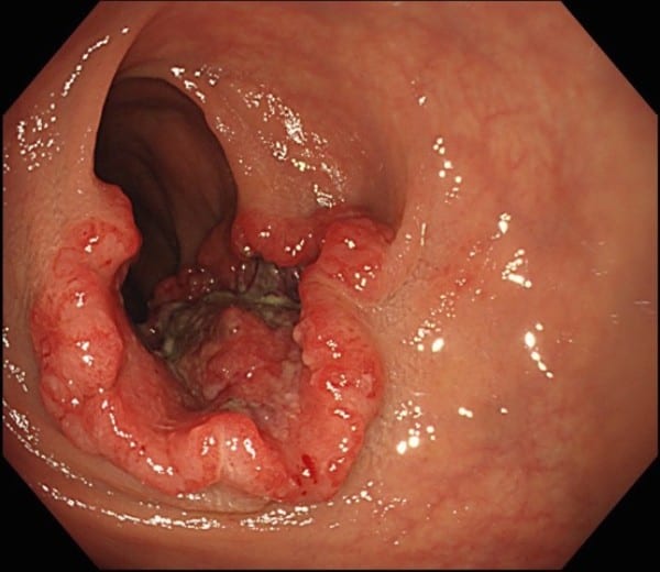 大腸がんの発見率が高いのは内視鏡医検査だ（提供／小泉医師）