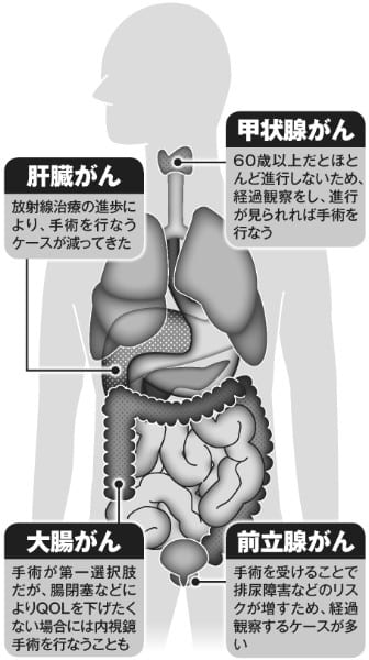 受けなくて済むがん4種