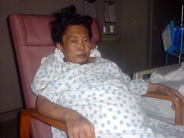 萩原さんは移植前の肝硬変による腹水に苦しんだという