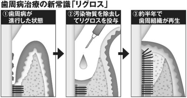 歯周病治療の新常識「リグロス」