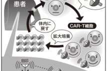 入院は数日…　最強がん治療「CAR-T細胞療法」、実用化間近