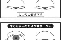 宮根誠司のプチ整形で話題、眼瞼下垂は重病の前兆可能性も