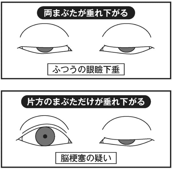 片方だけまぶたが垂れ下がると？