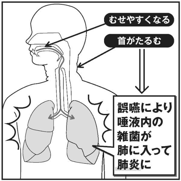 誤嚥のメカニズム