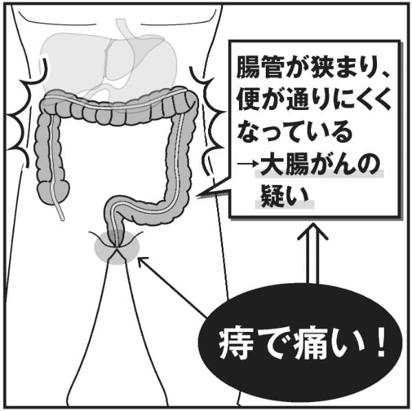 大腸がんの疑いがある状態とは？