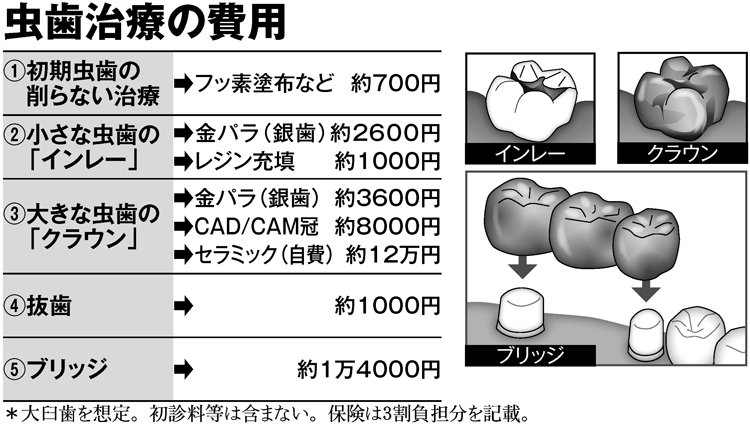 虫歯治療の費用は