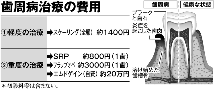 歯周病治療費の費用