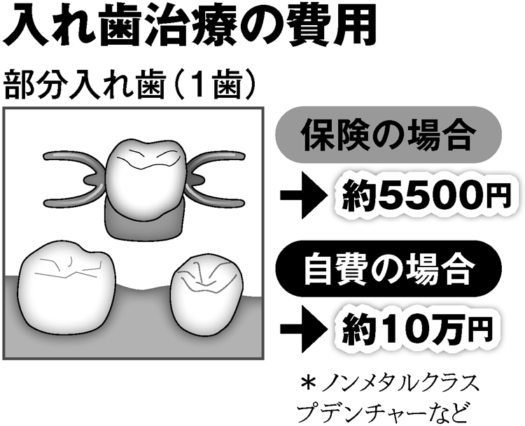 入れ歯治療の費用