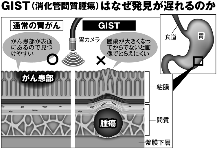 GISTはなぜ発見が遅れるのか