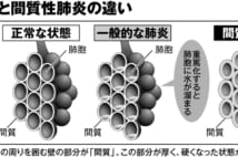 一般的な肺炎と間質性肺炎の違い