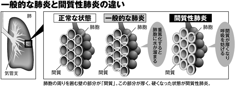 一般的な肺炎と間質性肺炎の違い