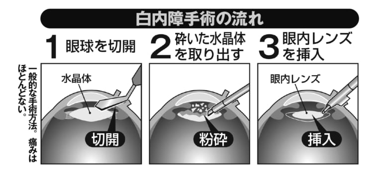 白内障手術の流れ