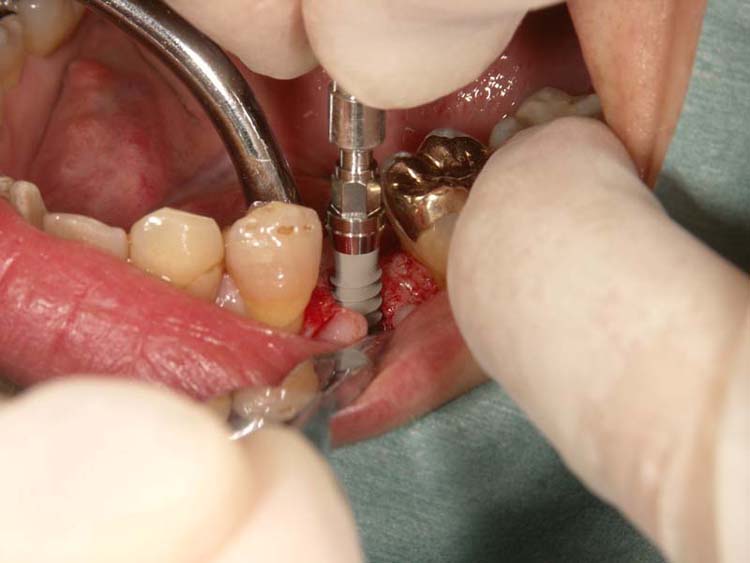 抜歯後のベストな治療は、インプラントか部分入れ歯か、それとも…？