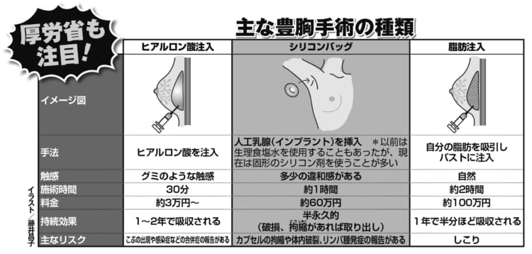 主な豊胸手術の種類