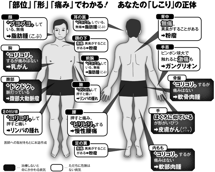 「部位」「形」「痛み」でわかるあなたの「しこり」の正体