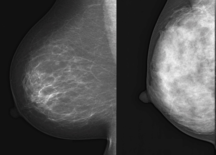 高濃度乳房（右）では、がん細胞が隠れて見えづらくなりやすい