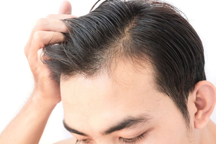 進化する増毛(写真/アフロ)
