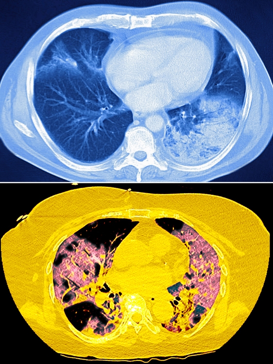 コロナによる間質性肺炎（下）では両方の肺全体に白い影が広がる（写真／GettyImages、時事通信フォト）