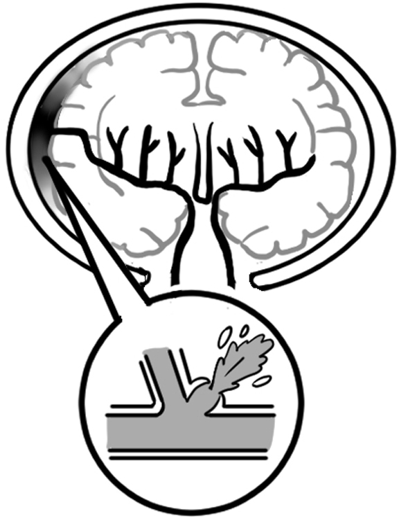 激しい頭痛を伴う