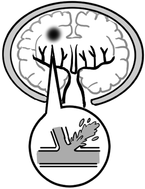 出血し、脳を傷つける