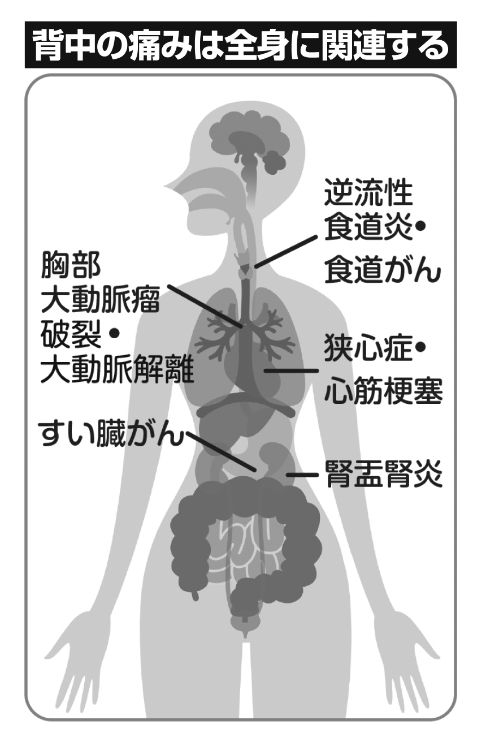 梗塞 背中 心筋 心筋梗塞のステントを入れた場合の予後